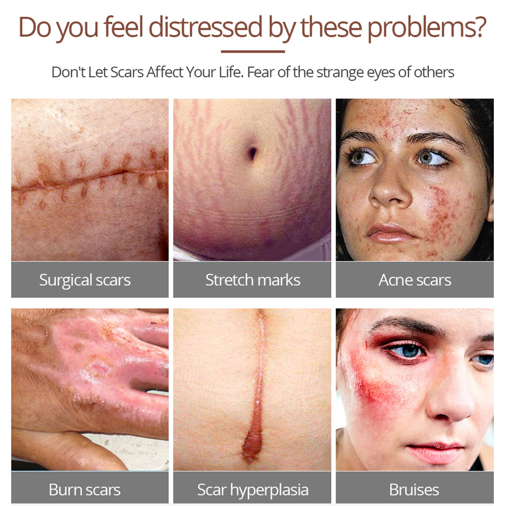 Scar Removal Essence 15g*1 to Repair Cesarean Section Bumps and