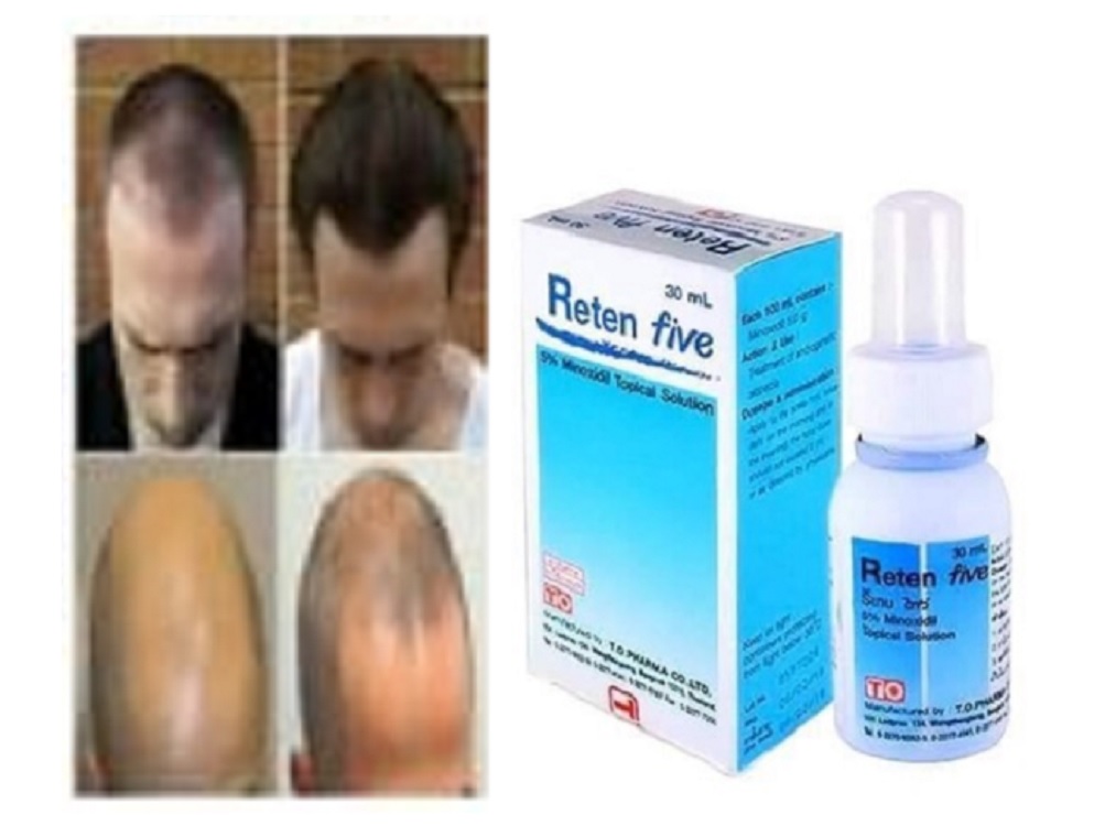 Reten Five 5 Minoxidil Topical Solution Hair Loss Treatment 30ml
