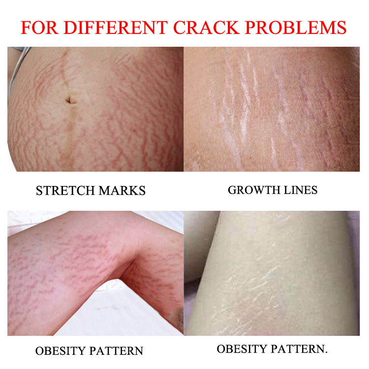 Love Yourself AICHUN Original Stretch Mark Removal Cream Pregnant Scar